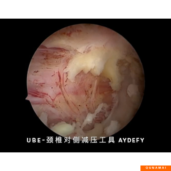 UBE surgery - cervical spine - contralateral decompression tool requirements