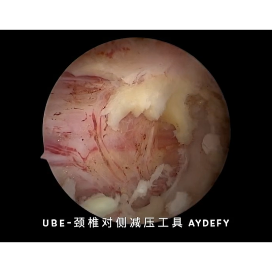 UBE surgery - cervical spine - contralateral decompression tool requirements