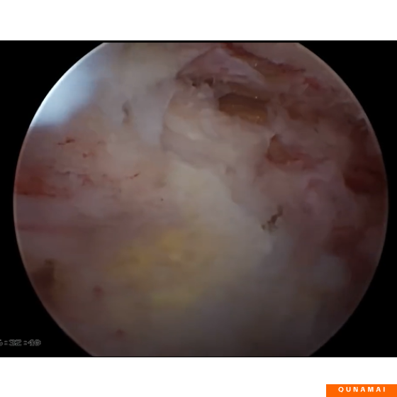 UBE Thoracic Floodwood Technique for Thoracic Ossification of Ligamentum Flavum (OLF)