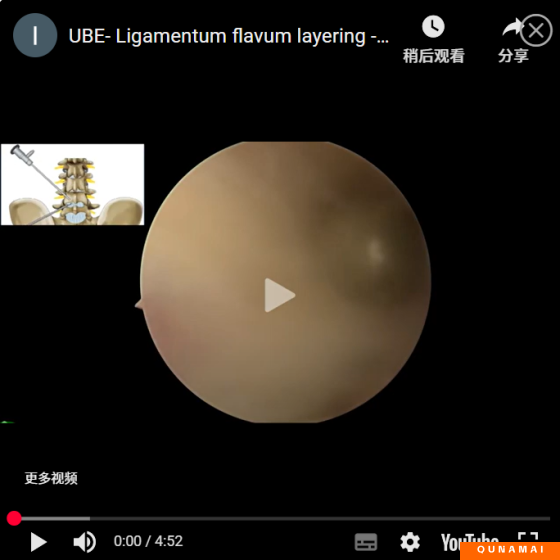 UBE- Ligamentum flavum layering -Corner area enters the spinal canal to operate AYDEFY