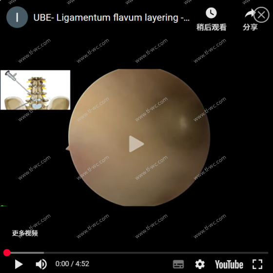 "UBE gelbbänder im hornbereich, um die operation mit dem rückenwirbel durchzuführen.