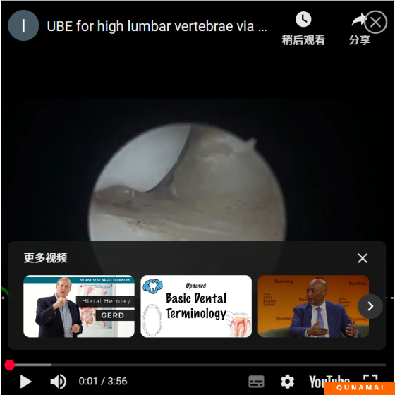UBE for high lumbar vertebrae via pedicle approach: Everything for thornness