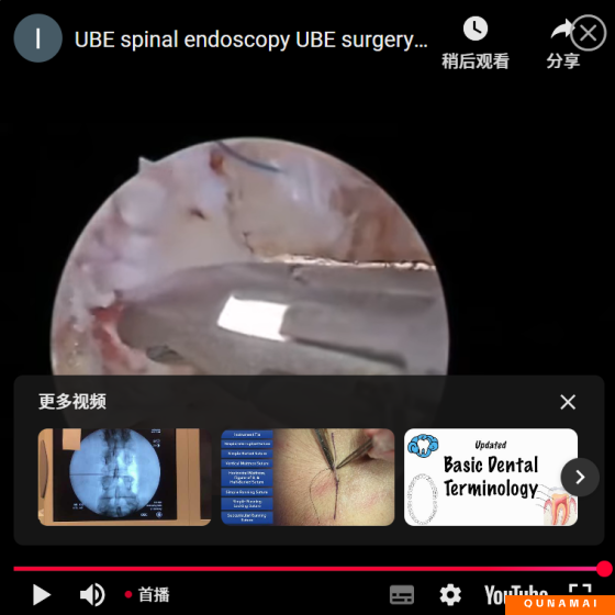 UBE spinal endoscopy UBE surgery annulus fibrosus suture video