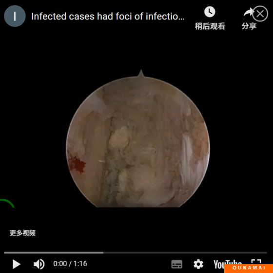 UBE surgery case: An infection case, with infection foci on both the upper and lower endplates of the L4 vertebra. Surgical operation video