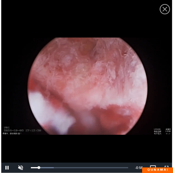 Transverse adjustment of the UBE surgical instrument - fusion device
