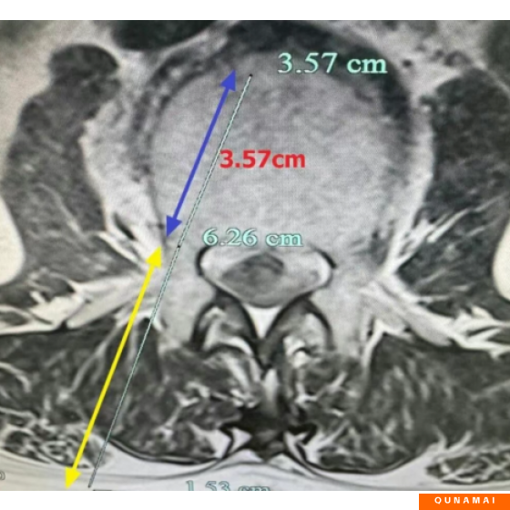 How to handle UBE intervertebral space, UBE intervertebral space preparation, and UBE fusion intervertebral space clearance