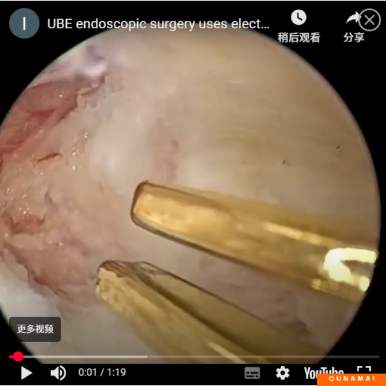 The use of bipolar electrocoagulation forceps in UBE endoscopic surgery