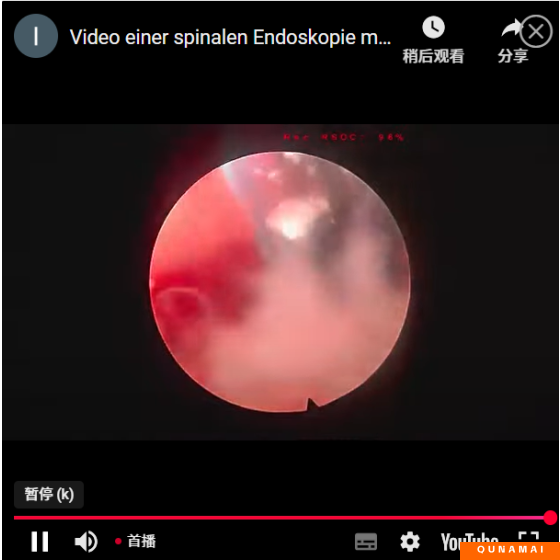 Single-portal full-process decompression video of spinal endoscopy
