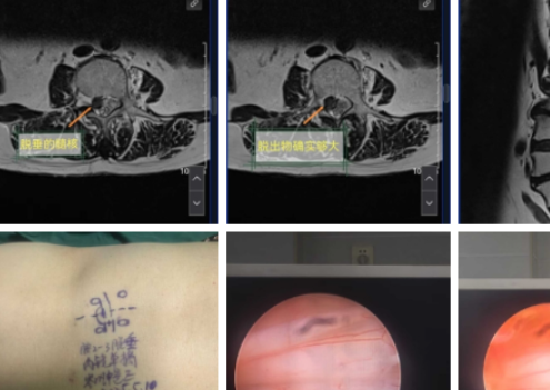 Kasus memperlakukan disk tinggi Lumbar raksasa menonjol dengan endoskopi Lumbar Percutaneous discektomi