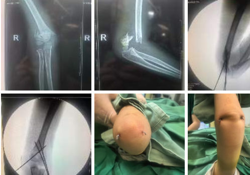 Keadaan darurat larut malam: demi kepentingan anak, kami memilih minimum pembedahan invasif