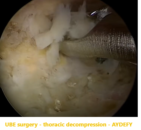 Penatalaksanaan prosesus artikularis inferior pada operasi revisi ExTLIF paraspinal
